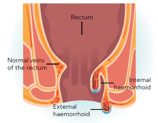 haemorroids-image-smiles-no-piles