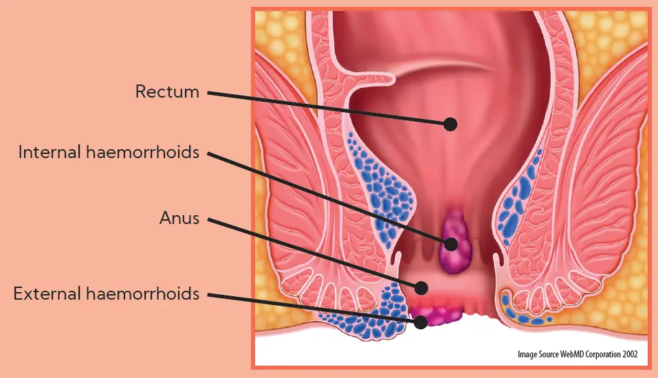 Haemorrhoid Diagram